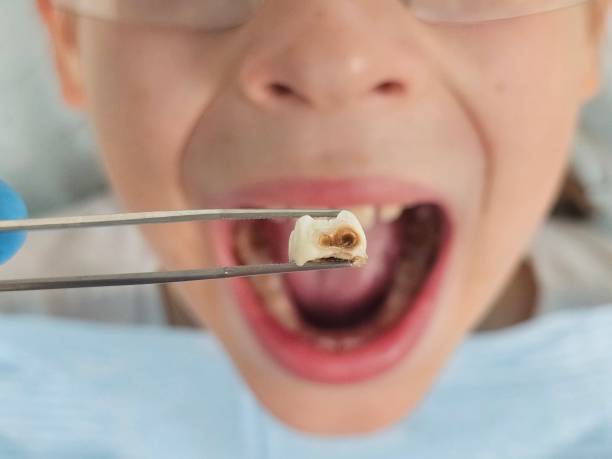 Best Emergency Treatment for Toothache in Sewalls Point, FL